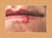 cold sore large framed image healthtips images